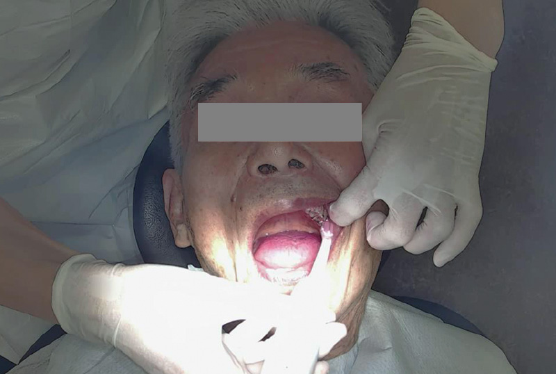 [写真] 「ソニッケアー」によるブラッシング指導の様子