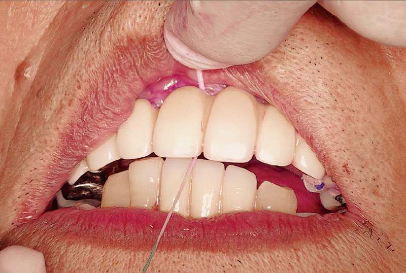 [写真] フロスと歯間ブラシを用いた清掃