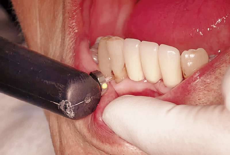 [写真] 「ダイアグノデント ペン」を用いた測定