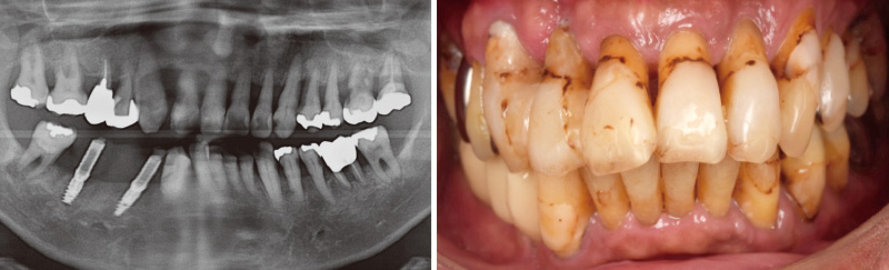 [写真] 2019年に₄ , ₆にインプラントを埋入