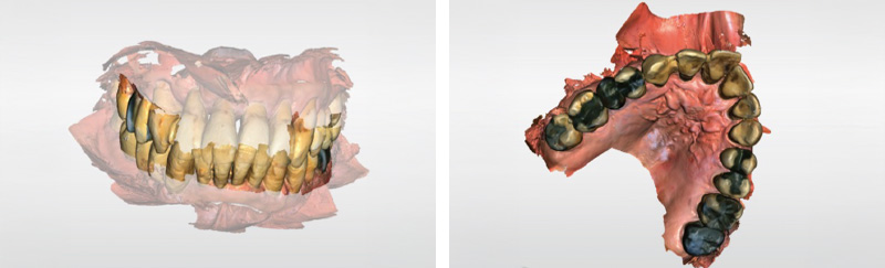 [写真] 口腔内スキャナー