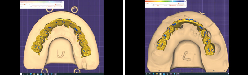 [写真] デジタル上で最終的な補綴装置の接触点を付与