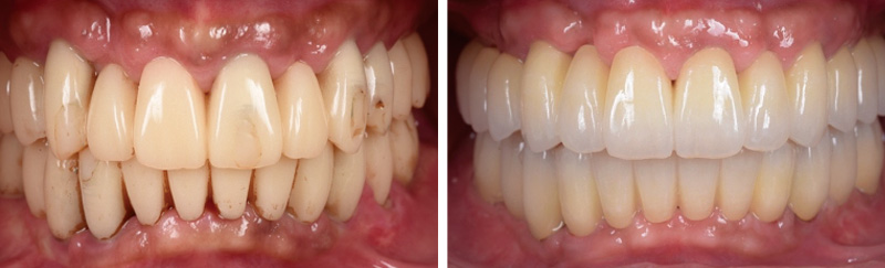 [写真] 写真左：プロビジョナルレストレーションをステージごとに装着し、審美性や清掃性を意識した形態を模索　写真右：2022年プロビジョナルレストレーションの形態を踏襲し、最終補綴を装着