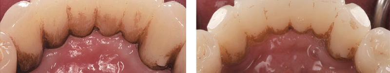 [写真] 「ソニッケアー6100」使用前。写真右：使用から2週間後の状態