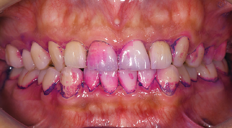 [写真] 初診時の染め出しの状態