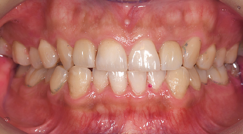 [写真] 「ソニッケアー6100」の導入直後