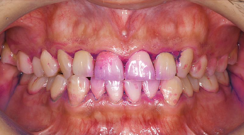 [写真] 初診から2週間後の染め出しの状態