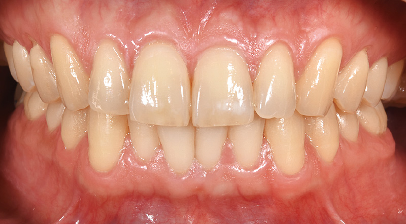 [写真] 「ソニッケアー6100」使用から2週間後の状態