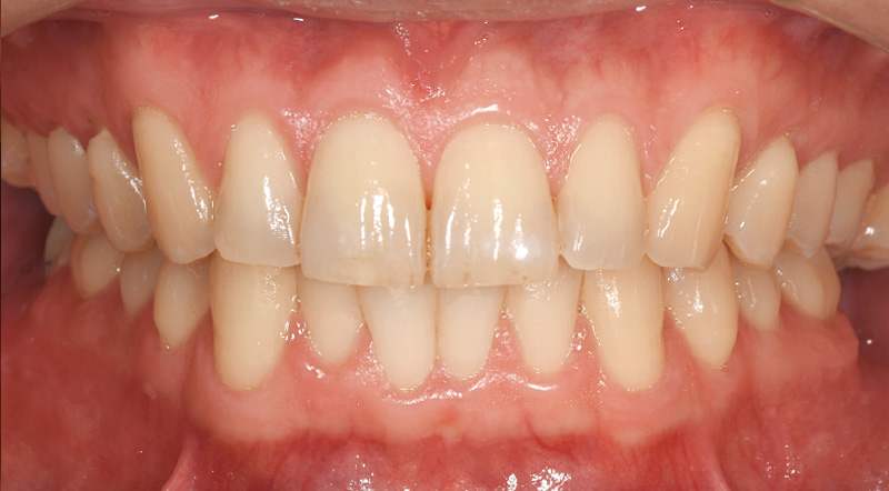 [写真] 「ソニッケアー6100」使用から3週間後の状態