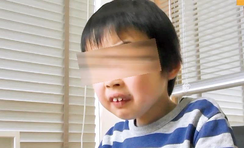 [写真] 前方頭位で口唇がいつも開いている7歳男児