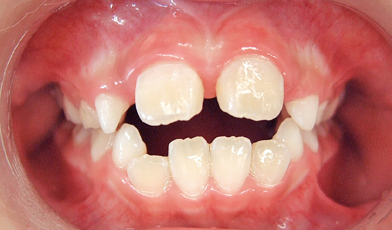 [写真] 6歳5か月の男児