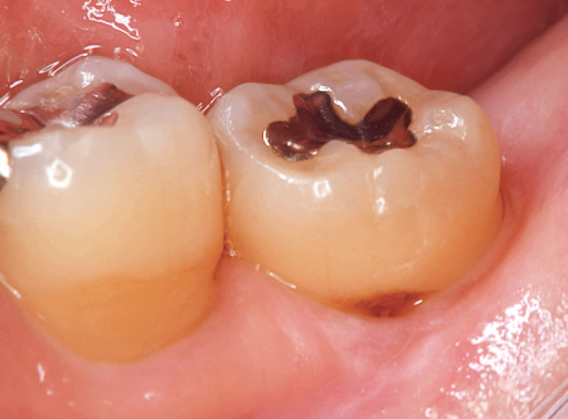 [写真] 中央歯頸部に歯肉辺縁う蝕が見られる