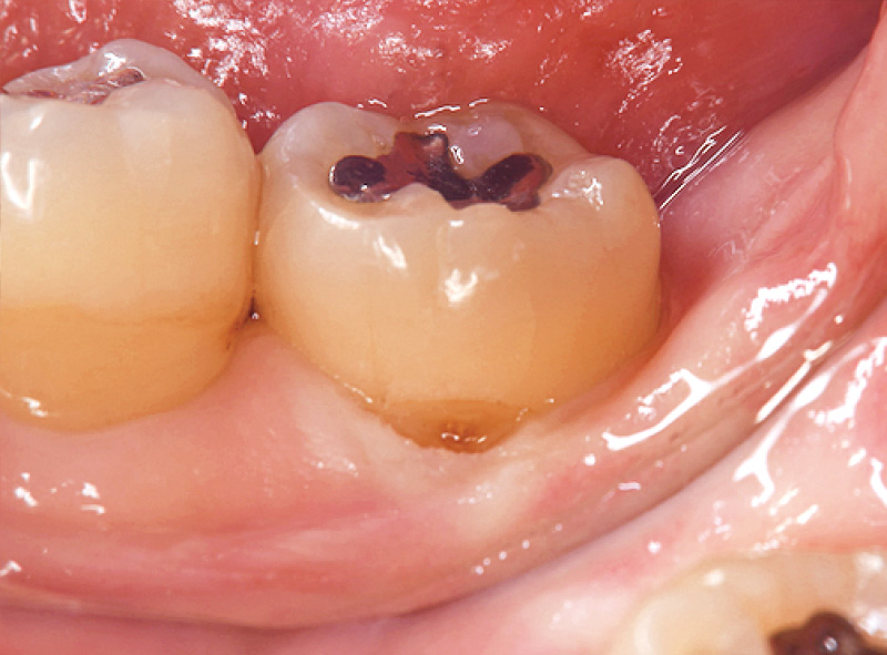 [写真] 歯肉切除