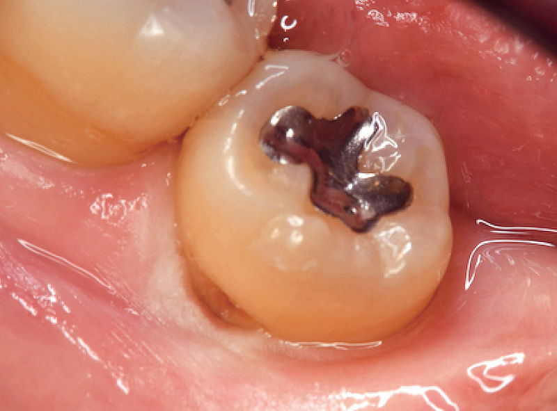 [写真] 咬合面方向から術野を観察