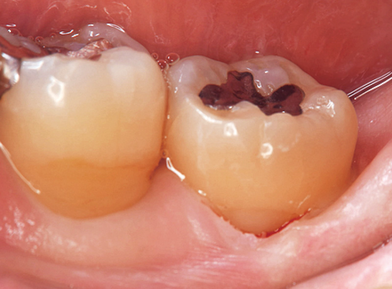 [写真] 術直後の状態