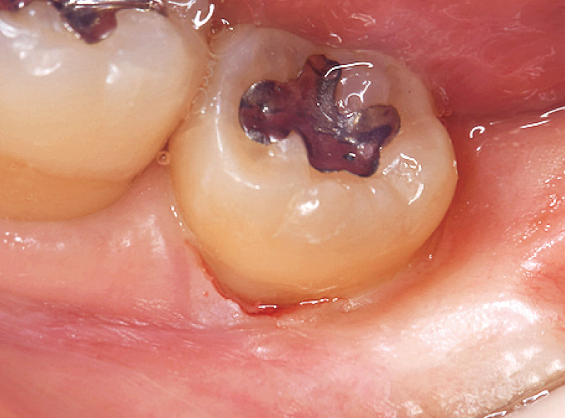 [写真] 咬合面方向から術野を観察