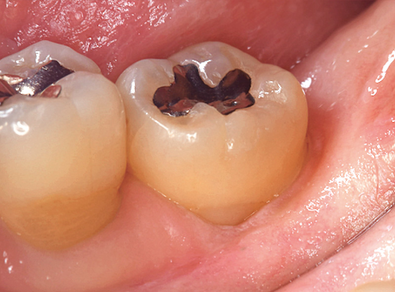 [写真] 術後1.5か月