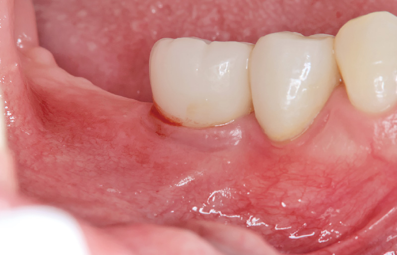 [写真] インプラント周囲炎にてBOP（＋）排膿を認める