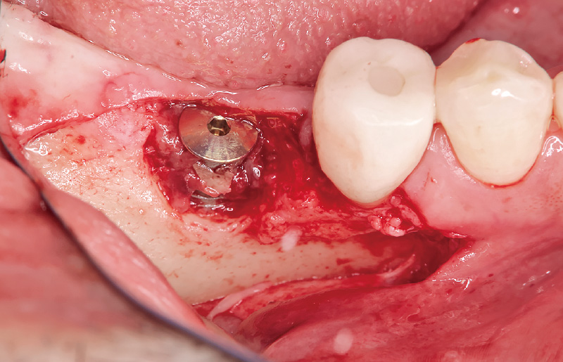 [写真] 頰側に骨欠損を認める