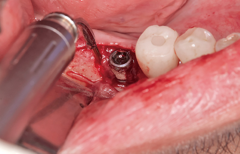 [写真] 感染組織を除去