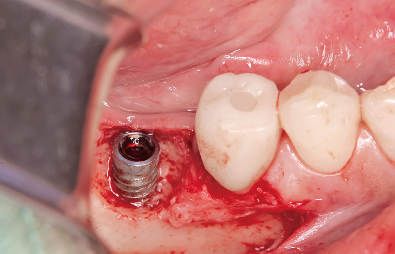 [写真] インプラント体に非接触でデブライドメントを行った