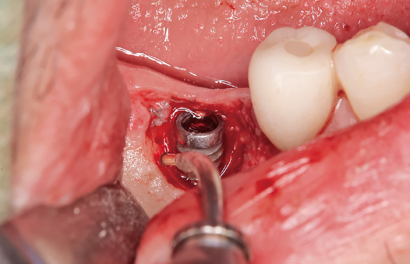 [写真] デコルチケーションを施行