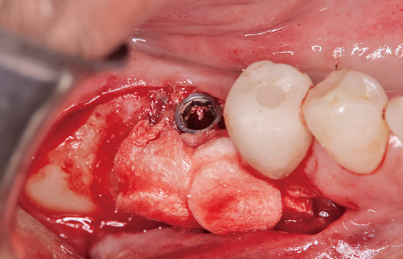 [写真] 骨補填材