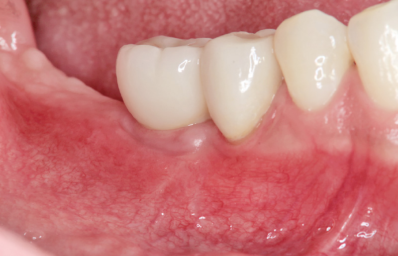 [写真] 再GBR後4か月