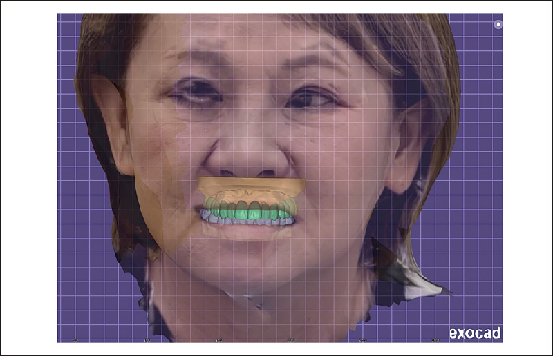 [写真] DICOMデータ、フェイススキャンデータ、そしてIOSデータからデザインしたデジタルワックスアップの3デジタルデータ