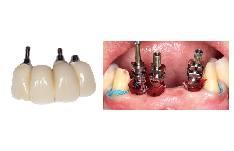 [写真] サブジンジバルカウンターを最終補綴物へトランスファーする