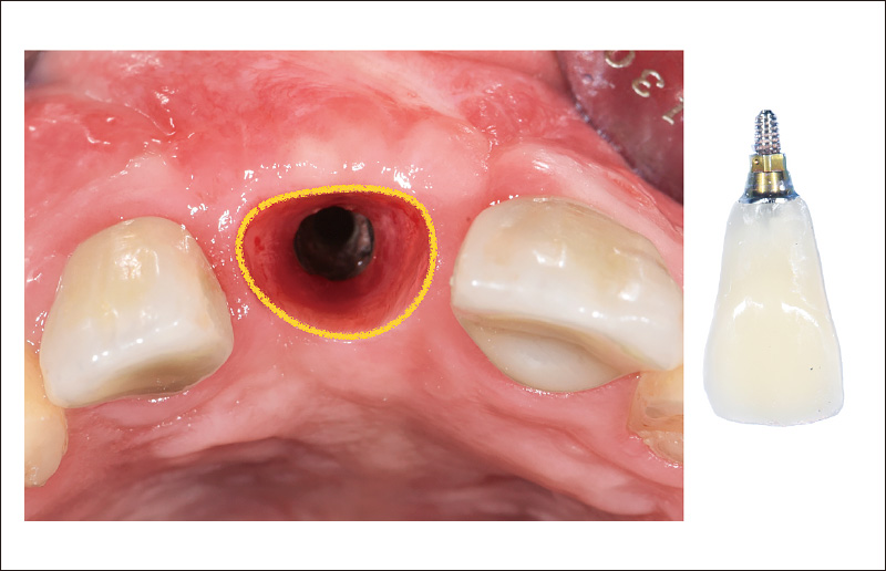 [写真] インプラント周囲軟組織のSoft Tissue Sculptingを行う