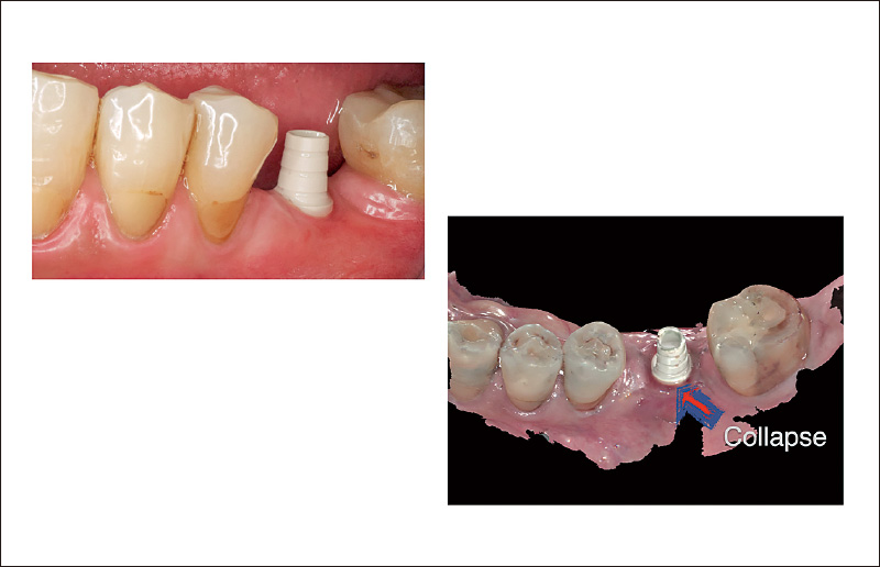 [写真] スキャンボディを口腔内に装着