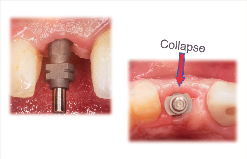 [写真] Soft Tissue Sculptingされた軟組織