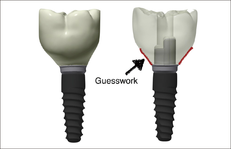 [写真] 最終補綴物をデザイン