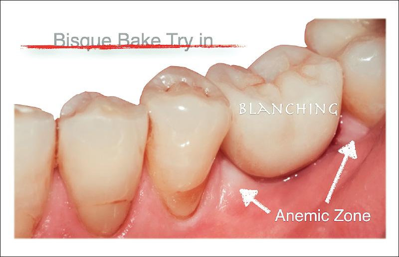 [写真] 歯肉縁下