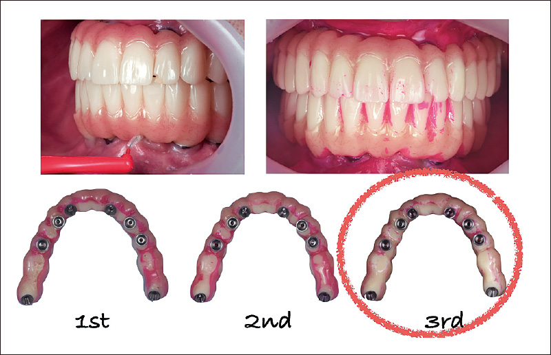 [写真] インプラント周辺やポンティック部の歯肉