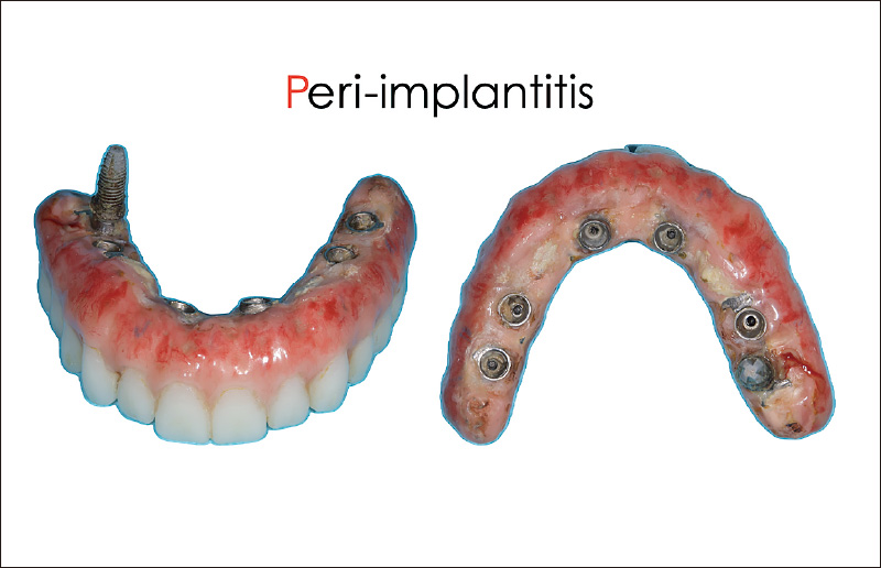 [写真] プロビジョナルレストレーション