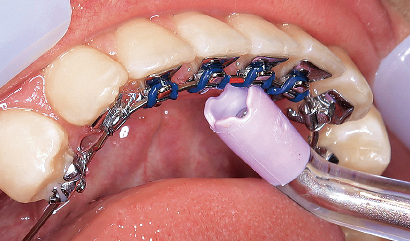 [写真] 「パワーフロッサー」のX型（4方向）に広がる水流