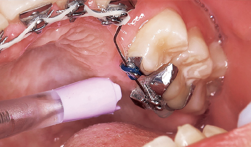 [写真] ブラケット矯正で使用するバンド部位の下面