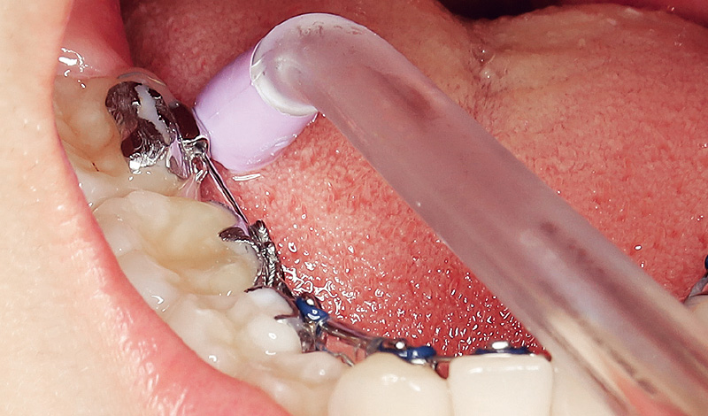 [写真] 「パワーフロッサー」の水流を上方向から下方向に当てる