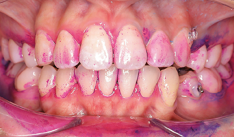 [写真] 「パワーフロッサー」と「ソニッケアー」使用前の状態