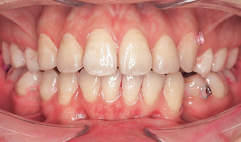 [写真] セルフケア後の状態