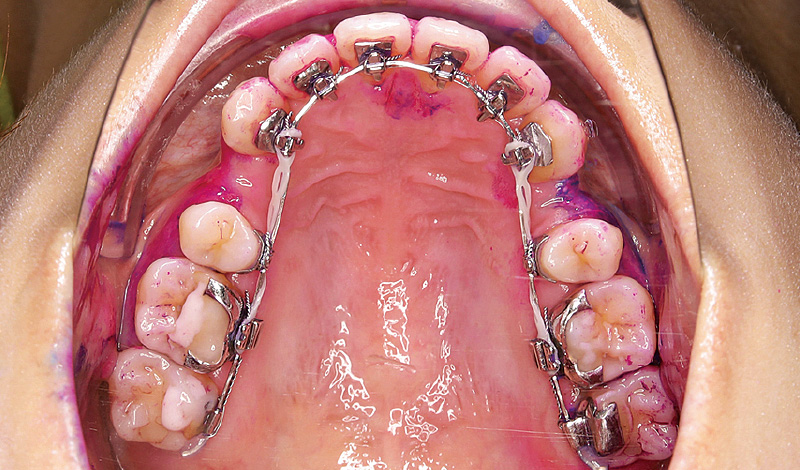 [写真] 「パワーフロッサー」と「ソニッケアー」使用前の口蓋側