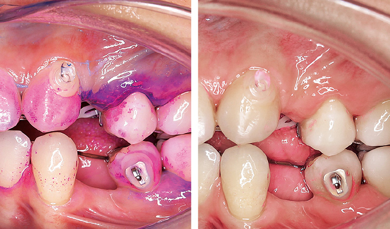 [写真] 抜歯した歯の隣接面