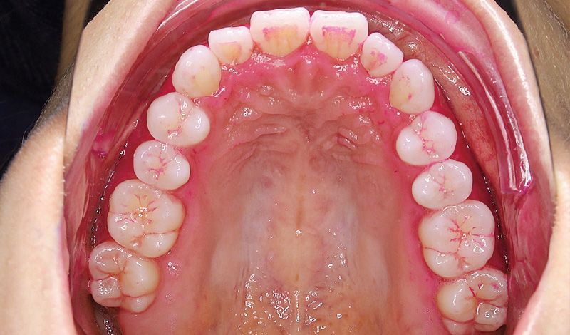 [写真] 「パワーフロッサー」と「ソニッケアー」使用前の状態