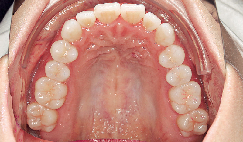 [写真] 「パワーフロッサー」と「ソニッケアー」を併用後の状態