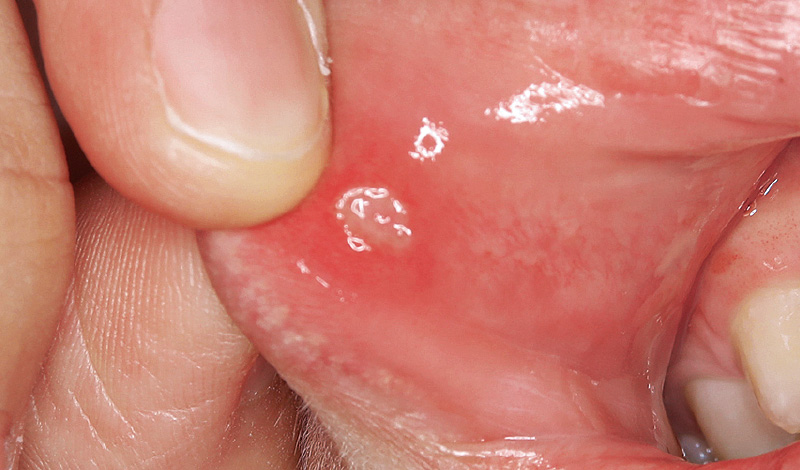 [写真] 矯正用のフックに接触することで起こる粘膜損傷や口内炎