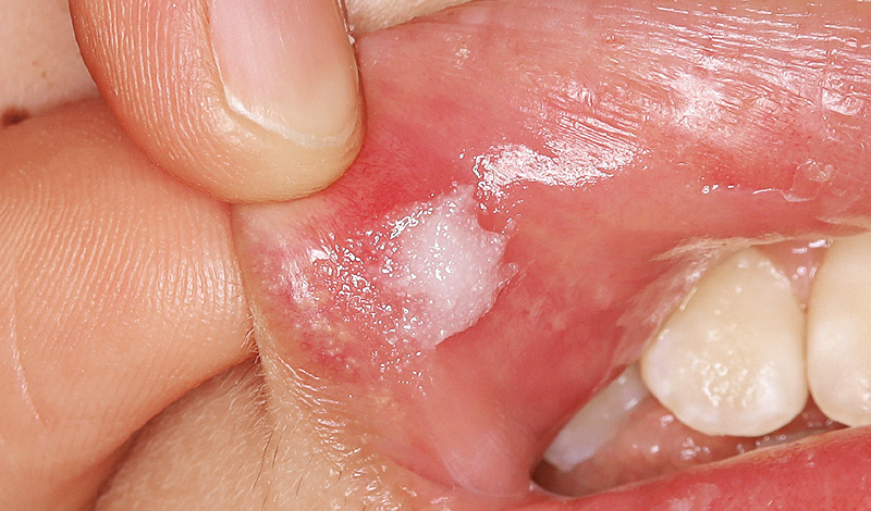 [写真] 「オラプラ」を口腔粘膜に塗布