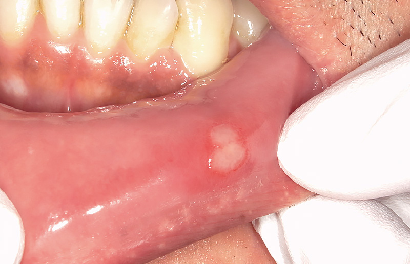 [写真] 下唇の口内炎