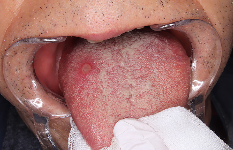 [写真] 誤咬による舌口内炎